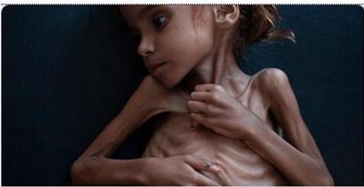 Yemen: Morta Amal, Bimba Simbolo Sofferenze Della Guerra