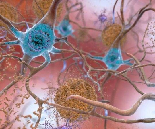 Human Brain Alzheimer Tau Protein Accumulate Tangles Neurons Hg