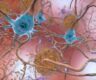 Human Brain Alzheimer Tau Protein Accumulate Tangles Neurons Hg