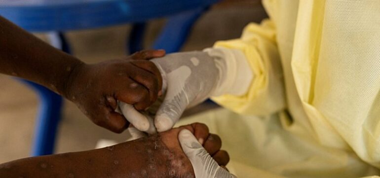 806x378 What We Know About The New Mpox Outbreak In Africa 1723566230806