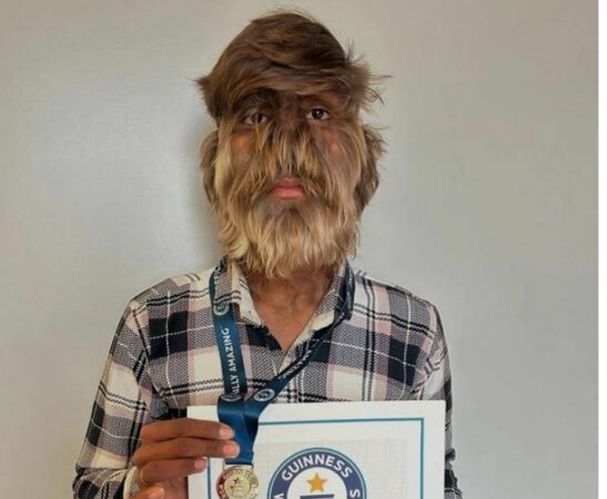 Sindroma E Ujkut Guinnes1