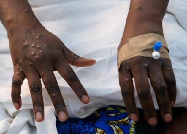 618202573605 J5fqi7t2g0 618202571404 Ghana Reports First Case Of Mpox This Year Strain Yet To Be Identified 2162213534