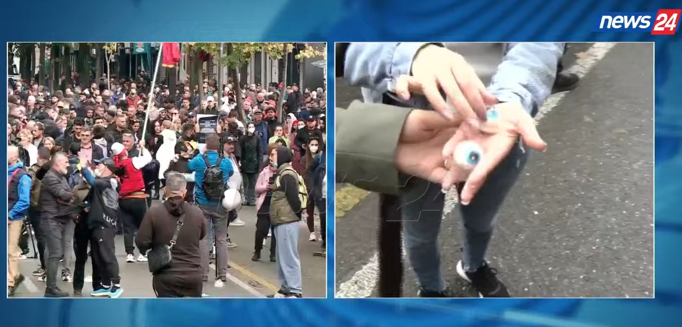 Foto nga burimi: “Në mëngjes ofron dialog, në darkë terror”/ Dëmtimet nga plumbat e gomës, protestuesja me sy plastikë me vete: Do ua jap policëve, t’u dalë inati me popullin