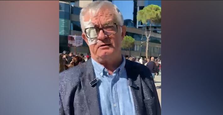 Foto nga burimi: “Larg duart nga studentët”/ Profesori që rrezikoi syrin nga plumbi i gomës së policisë, mesazh të fortë Ramës nga protesta: Largohu! E kemi zgjidhur kontratën me ty